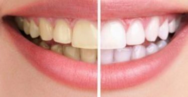 How to whiten your teeth with turmeric powder